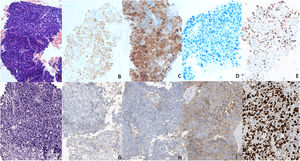 A–E (20×) Block cell from the baseline FNB showing an HCC in H&E (A), with positivity for hepatocyte markers (B, C) and negativity for synaptophysin (D). F–J (20×) Second liver biopsy showing a neuroendocrine carcinoma in H&E (F), with negativity for hepatocyte markers (G, H) and positivity for synaptophysin (I). (E and J) Ki67, showing a proliferation rate above 80% in the biopsy (J), much higher than in FNB (E).