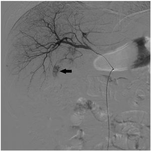 Arteriography of the common hepatic artery prior to embolisation showing a tumour lesion in the right hepatic lobe (black arrow) in relation to hepatocellular carcinoma supplied by the artery of segment VI in its supero-external half.