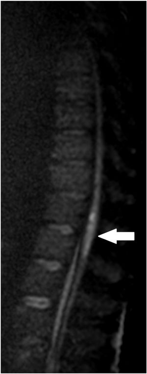 MRI. Sagittal plane of diffusion-weighted image showing diffusion restriction in the distal portion of the cord and conus medullaris (white arrow), possibly related to acute ischaemic injury.