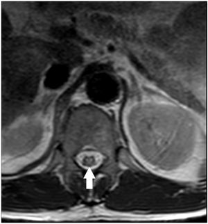 MRI. Axial T2-weighted image showing the classic “Owl