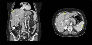 Coronal and transverse sections of abdominal CT showing multiple hepatosplenic lesions consistent with sarcoidosis involvement.