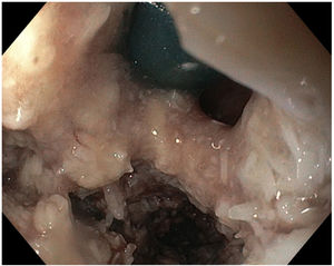 Upper gastrointestinal endoscopy image of the bronchoesophageal fistula after placement of a bronchial prosthesis via bronchoscopy.