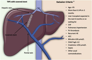 Transjugular intrahepatic portosystemic shunts with covered stents and exclusion criteria for placement. LVPs: large-volume paracenteses, CHF: congestive heart failure, PV: portal vein, HE: hepatic encephalopathy, HCC: hepatocellular carcinoma.