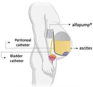 The automated low-flow ascites pump (ALFApump) system.