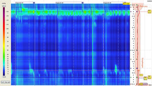 High resolution esophageal manometry of a patient with mitochondrial neurogastrointestinal encephalomiopathy showing failed contractions with hypotensive LES and UES, without panpressurization.