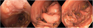 Colonoscopy findings.
