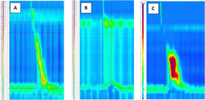 High-resolution manometry recordings in 3 patients presenting with esophageal symptoms. A. Esophagogastric junction outflow obstruction. B. Type II achalasia. C. Type III achalasia.