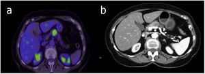 a) Axial PET/CT image with pathological uptake in the body of the pancreas (SUVmax 6.14). b) Axial CT image with lesion in the body of the pancreas and dilation of the main pancreatic duct.