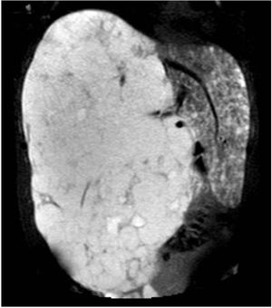 Coronal slice of contrast-enhanced MRI of the liver, T2-weighted sequence, showing hepatomegaly occupying both hypochondriac regions and reaching the iliac crest. The liver parenchyma is completely occupied by lesions compatible with haemangiomas.