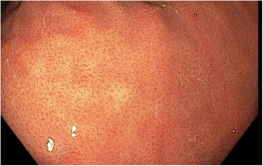 Endoscopic diagnosis of H. pylori infection | Gastroenterología y ...