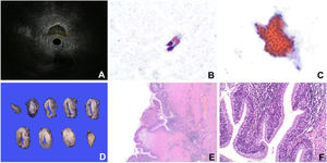 A: Endoscopic Ultrasound shows a hypoechoic lesion with had well-defined regular borders and is not dependent on the rectal wall. B: Cytologic findings: Ciliated cylindrical epithelial cells without atypia. C: Occasional groups of transitional-like epithelial cells. D: Gross findings: sections of the cyst showed a 2mm thick wall with a delicate muscular layer, whitish fibrous tissue, and yellowish areas of medium consistency. E: Microscopic findings: some areas the epithelium showed a transitional appearance (H&E ×10). F: Higher power view showing a cystic lesion lined by non-dysplastic ciliated columnar pseudostratified glandular epithelium with mucinous cells (H&E ×20).