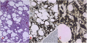 Pathological and immunohistochemical analysis. A) Pathology (H&E, 4×): epithelioid cells, highly vascularised, with a large lattice of adipose tissue. B) Immunohistochemistry: positive for HMB-45, in contrast to adjacent pancreatic parenchyma. C) Immunohistochemistry: cytoplasmic positivity for MELAN-A.