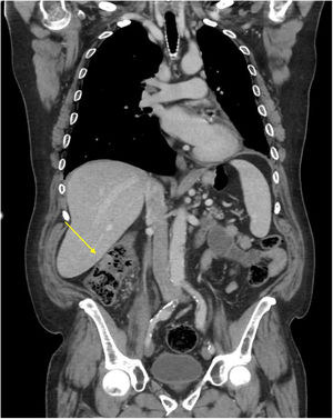 CT scan: asymmetric mural thickening of the ascending colon (arrow) with fat reticulation and adjacent vascular engorgement.