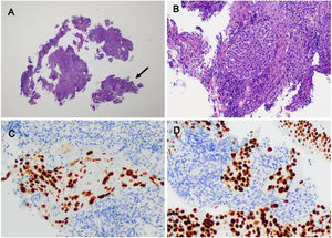 Pathology: (A) haematoxylin-eosin ×2: colon biopsy with marked inflammation (arrow); and (B) haematoxylin-eosin ×10: colon biopsy with neoplastic cellular nidus. (C) Neoplastic cellularity positive for anti-P40 antibody in colon (×20); and (D) endobronchial primary lesion (×20) confirming squamous origin.