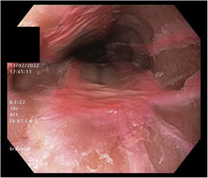 Oesophagus with signs of oesophagitis (30 cm upper dental arch).