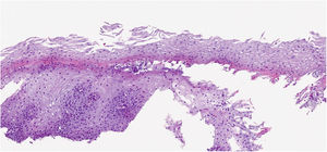 HE. 12.2× Cleft with desquamation of the most superficial part of the epithelium, with parakeratosis and scant inflammation with some lymphocytes. Some foci of bacterial colonisation (right).