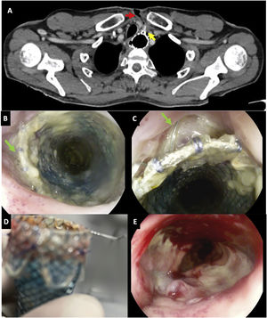 (A) Cervical CT image showing the esophageal fistula penetrating the subcutaneous cellular tissue (red arrow) secondary to the steel retrieval wire of the SEMS (yellow arrow). (B, C) Endoscopic image showing the esophageal SEMS and the steel retrieval wire penetrating the esophageal wall transmurally before its removal. (D) SEMS image after removal, verifying that the steel retrieval wire was deformed. (E) Endoscopic view of the esophageal mucosa after removal of the SEMS, where healing of the anastomotic dehiscence was observed, so a new SEMS was not placed. SEMS: self-expandable metal stent.