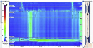 Manometry recording of the patient. In addition to increased LOS tone (48 mmHg), we found increased integrated relaxation pressure (25 and 23 mmHg/4 s lying down and upright respectively) and pan-oesophageal pressurisation without peristaltic wave generation, manometry findings compatible with type II oesophageal achalasia. PIP: pressure inversion point; TZ: transition zone.