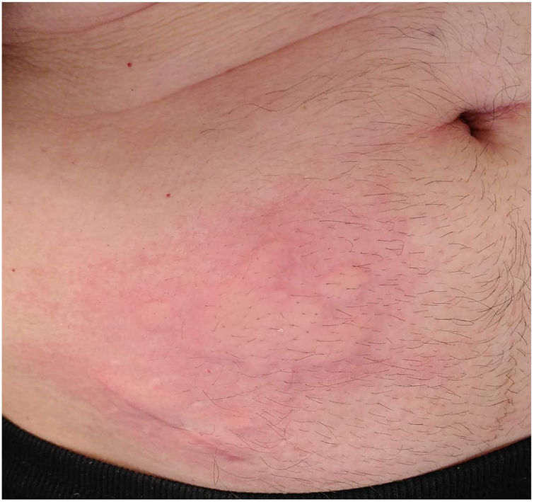 Recurrent skin reaction at the site of former subcutaneous injection ...