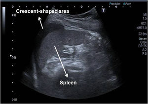 B-mode ultrasound image. Subdiaphragmatic, hypoechogenic crescent-shaped area at the perisplenic level.