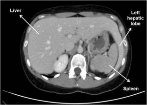 CT scan image. Left lobe extends laterally to contact and enclose the spleen.