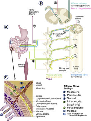 Representation of nerve pathways involved in the processing and integration of visceral nociceptive signals originating in the gastrointestinal tract. In contrast to somatic nerve pathways (for example, from skeletal muscle), which have a clear somatotopic organisation in the central nervous system, pathways of visceral origin terminate at multiple levels in the spinal cord, giving visceral pain (including gastrointestinal) its diffuse character and showing a complex organisation (A). Visceral afferents converge with somatic pathways at the dorsal horn of the spinal cord (viscero-somatic convergence),1 which explains the phenomenon of referred pain. Primary visceral afferents can divide to terminate simultaneously at multiple levels in the spinal cord.2 In the spinal cord, there may also be convergence of afferents from different viscera (viscero-visceral convergence).3 This would explain why gastrointestinal disorders can cause symptoms in remote organs/viscera. Visceral afferent pathways reach the spinal cord with sympathetic nerves, which may produce sympathetic autonomic reflexes associated with visceral stimulation.4 The parasympathetic afferent component (vagus nerve and other parasympathetic nerves)5 normally mediates non-nociceptive physiological reflexes, but its integration at the base of the brain (brainstem) may modulate the activity of descending spinal pain modulatory systems (B-6). The enteric nervous system7 may also be involved in modulating sensory activity and associated autonomic reflexes, which may explain some of the symptoms associated with intestinal pain, such as motor and secretory disturbances. (C) Detail of the sensory afferent endings in the gastrointestinal tract. Nerve endings are located in all layers of the intestine, as well as in blood vessels and mesentery. Intramuscular and intraganglionic endings (4 and 5 in the figure) have no proven role in the transmission of pain stimuli. Source: Modified from: Knowles et al.70; Drewes et al.71; and Martinez.4
