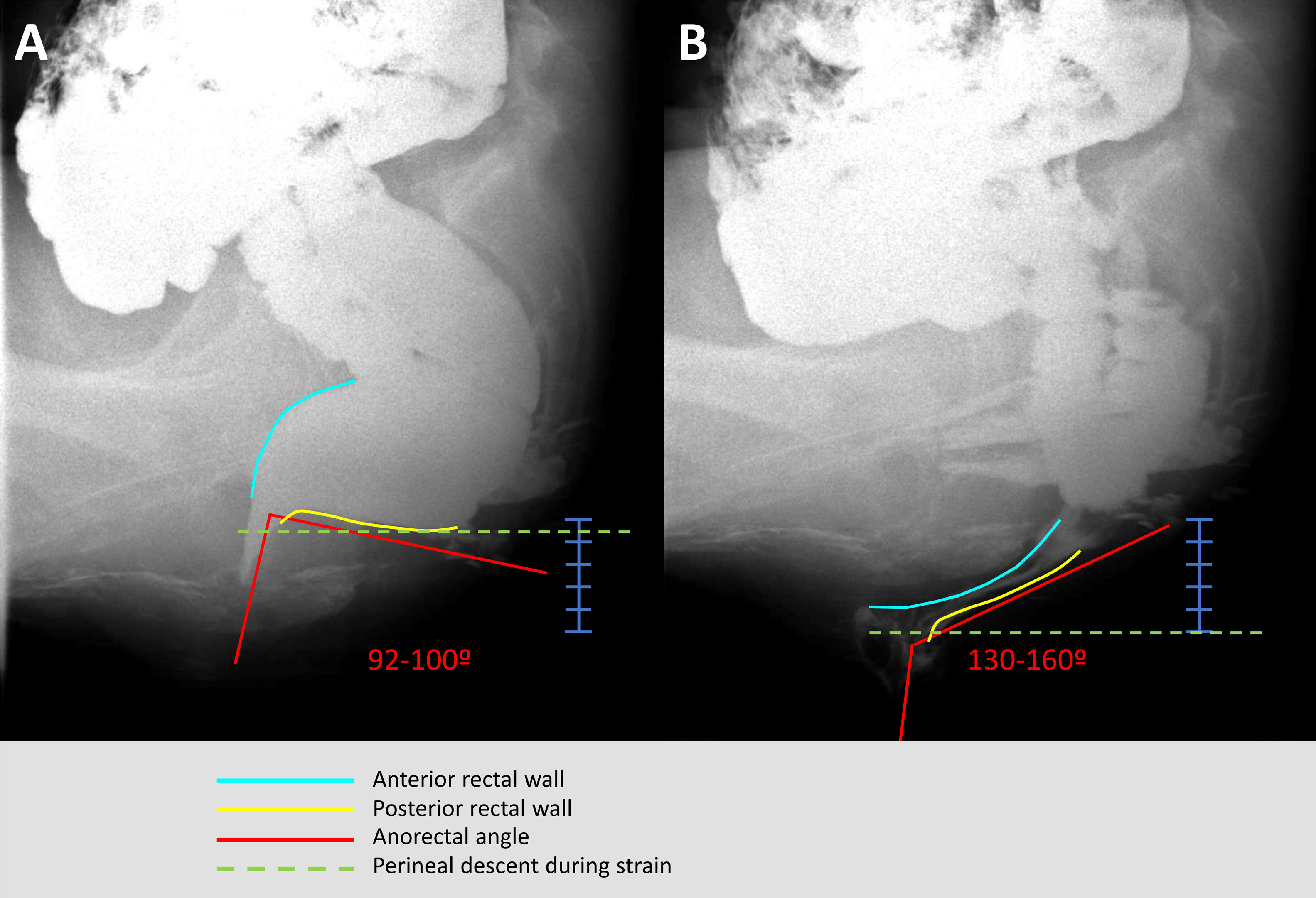 Obstructive Defacation Characterization of obstructive defecation from a structural and a ...