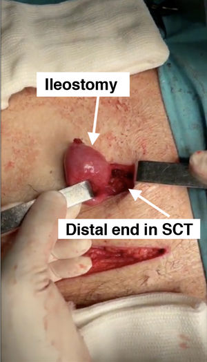 Image illustrating the creation of an ileostomy in a patient operated on for fistulising CD in which the distal end of the colon opens into the subcutaneous cellular tissue (SCT), preventing complications if it opens during the postoperative period, and in turn facilitating the subsequent bowel transit reconstruction surgery in a second stage.
