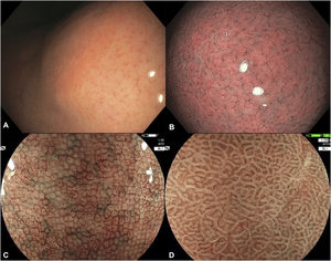 Endoscopic findings of a normal gastric mucosa. (A) Regular arrangement of collecting venules (RAC) on high-definition white-light endoscopy; (B) RAC and normal corporal pit pattern on narrow band imaging (NBI); (C) Supra-angular pit pattern and subepithelial capillary network with a ‘honeycomb’ appearance on blue light imagine (BLI) and magnified endoscopy (ME); (D) Normal antral microsurface and microvascular pattern on BLI and ME. Images C and D were kindly provided by Dr. Robert Bechara.