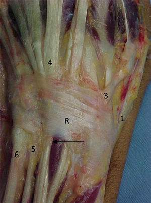 Anatomy of the retinaculum of the extensor tendons (R) with its compartments. 1: first extensor compartment; 2: compartment for the long and short radial extensor carpi; 3: for the long extensor of the thumb; 4: for the extensor digitorum communis and for the extensor of the 2nd finger; 5: for the extensor of the 5th finger; 6: for the extensor carpi ulnaris. The synovial that surrounds the tendons is pointed with an arrow.