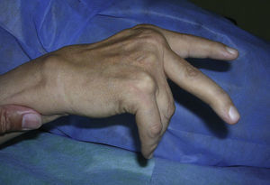 Patient with caput ulnae with impossibility for extension due to rupture of the extensor tendons of the 4th and 5th fingers.