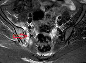 Simple nuclear magnetic resonance with inversion-recovery sequence (STIR) of sacroiliac joints. The arrow shows the inflammatory changes in periarticular soft tissues.