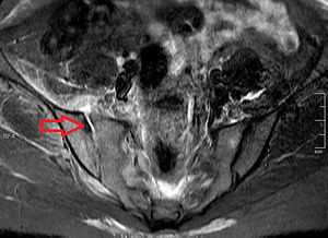 Simple nuclear magnetic resonance with inversion-recovery sequence (STIR) of sacroiliac joints. The arrow shows the increase of joint fluid as well as an erosion of the iliac bone.