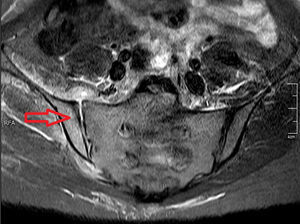 Simple nuclear magnetic resonance with inversion-recovery sequence (STIR) of sacroiliac joints. The arrow shows the bone marrow edema at the level of the iliac bone.