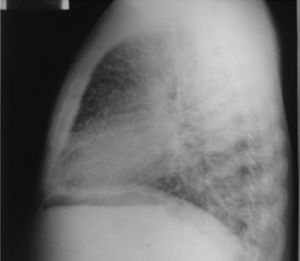 Lateral chest radiography.