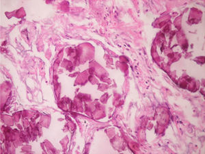 Alveolar microliths.