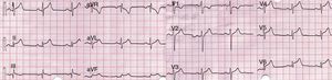 12-lead EKG. Concave elevation of the ST segment in the inferior and lateral leads. PR elevation in aVR.