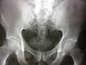 Pelvis X-ray. Sclerosis of the sacroiliac joints.