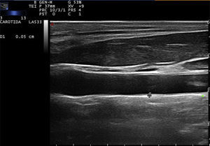 Echographic image showing the carotid intima-media thickness taken with the conventional method.