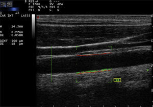 Echographic image showing the carotid intima-media thickness taken with the automated radiofrequency-based method.