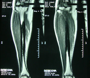 MRI of the right leg with coronal section in T2 where it can be seen a hypointense lesion in the diaphyseal region of the tibia that spares the cortical.