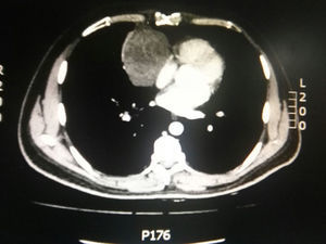 Chest CT scan with mediastinal mass in the right costophrenic angle.