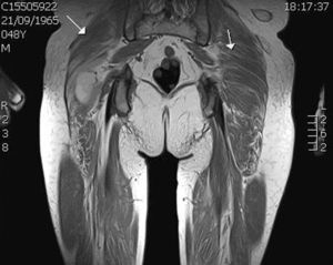 Nuclear magnetic resonance imaging of the pelvic girdle with evidence of severe atrophy, but with hyperintensity in STIR sequences and total postcontrast of the vastus lateralis until formation of the lateral retinaculum (arrows).