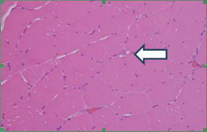 Presence of endomysial cells of lymphoid appearance (arrow). Hematoxylin–eosin staining. 40× magnification.