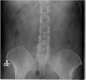See the alteration in the lumbosacral transitional vertebra with a sacral lumbarization and increase of both transverse processes of L5, more pronounced in the right side.