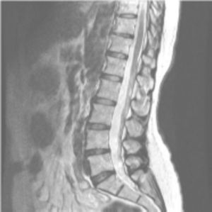 The nuclear magnetic resonance reveals some degree of disk dehydrations with moderate diffuse bulgings of annulus fibrosus of intervertebral discs L4-L5 and L5-S1 with a small posterior annular tear at the level of L5-S1. It also shows interapophysial degenerative phenomena that cause decrease in the caliber of foramina at L4-L5 and L5-S1 levels, of greater connotation at the right L4-L5 level.
