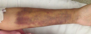 Left forearm with edema and ecchymosis.