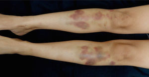 Violaceous nodules and ecchymosis in both tibiae.