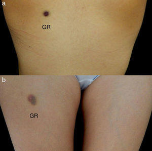 Intradermal sensitization test with washed autologous erythrocytes. (a) Scapulae. (b) Thighs. Positive subcutaneous test for the diagnosis of psychogenic purpura at 48h. GR: autologous erythrocytes.