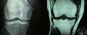 At the left side on the AP radiography of the knees is observed calcification of the medial collateral ligament in its proximal portion, in addition to a decrease in the medial femorotibial space. At the right side in the coronal acquisition with T1 information of the knee becomes evident an ossification in the proximal end of the medial collateral ligament, in relation with an old-injury, configuring a Pellegrini–Stieda lesion. Osteoarthritic changes with formation of marginal osteophytes in the medial compartment are also observed.